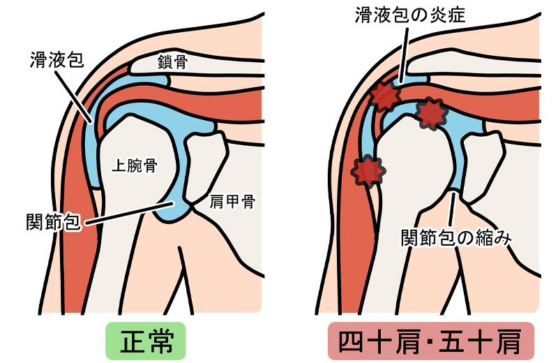 四十肩・五十肩