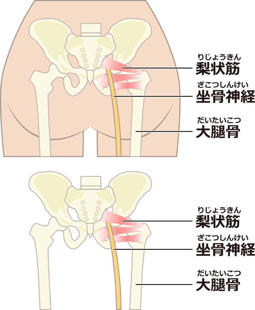 坐骨神経痛